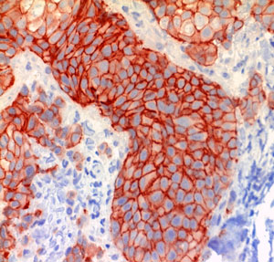 Her2-neu-Immunhistochemie